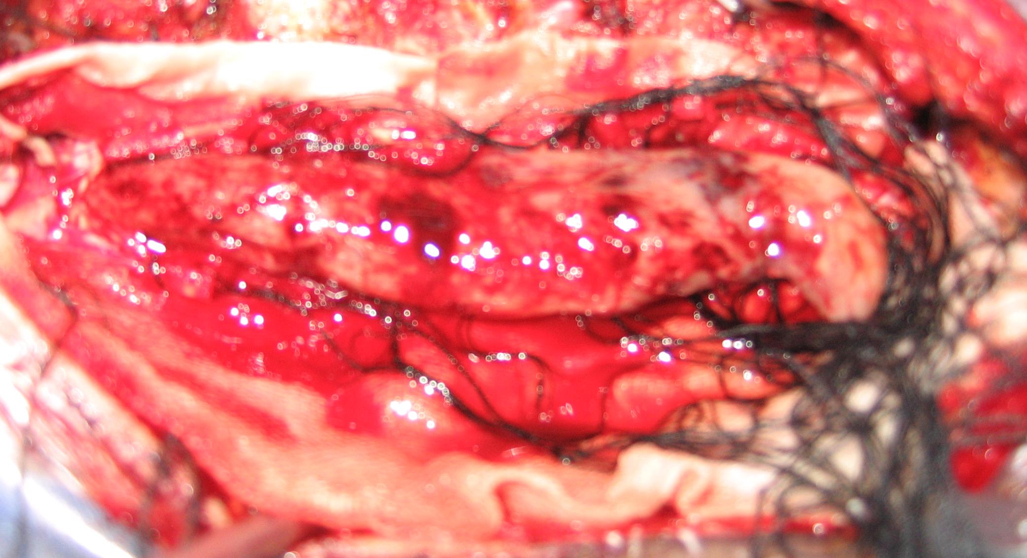 延髓至颈7巨大室管膜瘤(神外三)